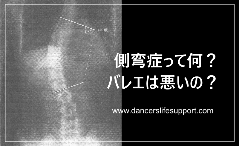 側弯症って何 バレエは悪いの Dancer S Life Support Com