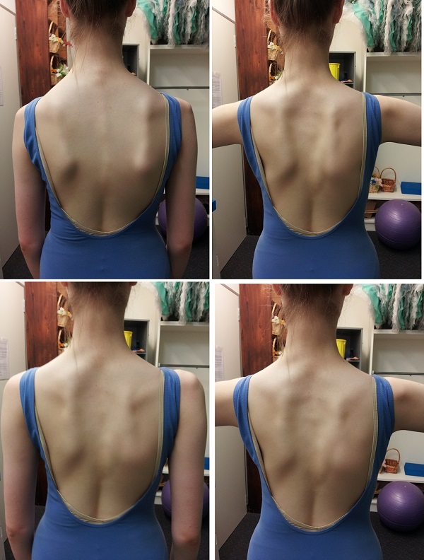 側弯の例：上の2枚が普通のポーデブラ、下の2枚が肩の意識をしたポーデブラ　100%でなくても肩甲骨が中に入り、肩が開かれて背骨が伸びているのも見える